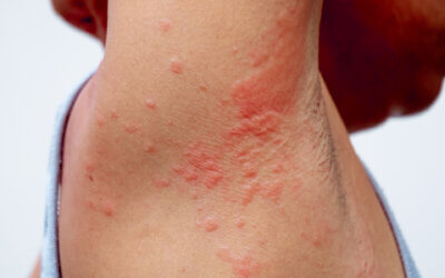 What Causes a Skin Rash? What is Contact Dermatitis?